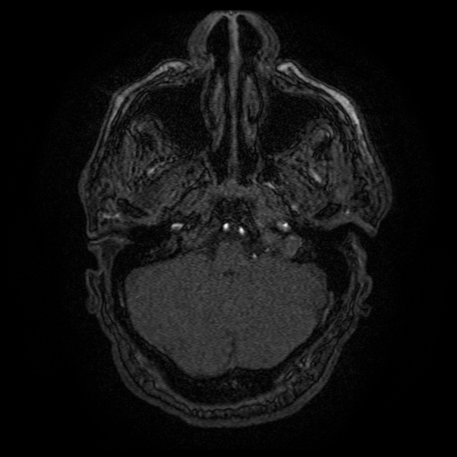 Carotid arterial dissection with acute cerebral infarction (Radiopaedia 26636-26784 MRA 145).jpg