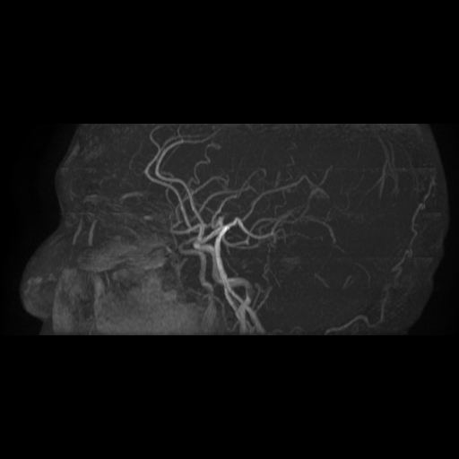 Carotid arterial dissection with acute cerebral infarction (Radiopaedia 26636-26784 MRA 4).jpg