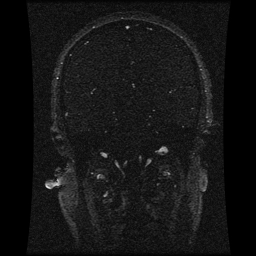 Carotid arterial dissection with acute cerebral infarction (Radiopaedia 26636-26784 MRV 90).jpg