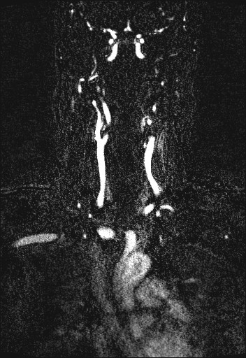 File:Carotid artery dissection (Radiopaedia 28441-28689 Coronal MRA 33).jpg