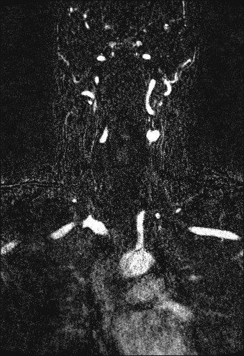 Carotid artery dissection (Radiopaedia 28441-28689 Coronal MRA 42).jpg