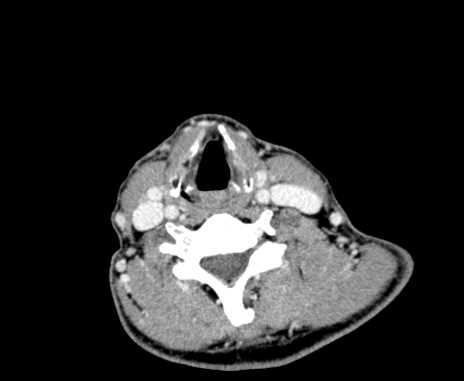 File:Carotid body tumor (Radiopaedia 61750-69757 Axial Post contrast 77).jpg