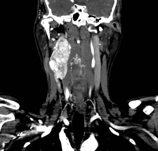 File:Carotid body tumor (Radiopaedia 83615-98727 B 68).jpg