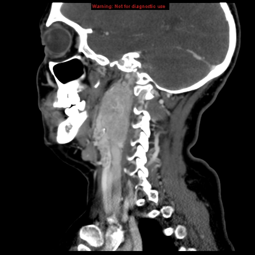 Carotid body tumor with lung metastases (Radiopaedia 9301-9986 Sagittal C+ delayed 35).jpg