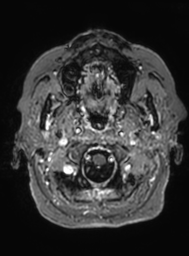 File:Cavernous hemangioma of the cerebellar falx (Radiopaedia 73025-83724 Axial T1 C+ 321).jpg