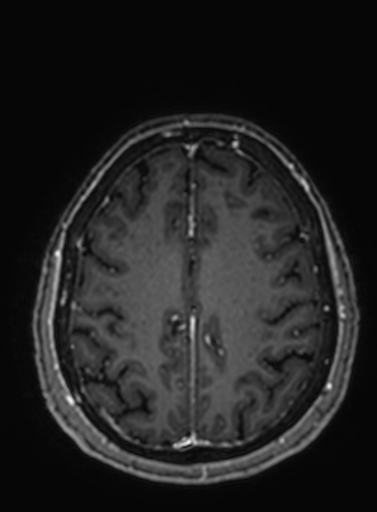File:Cavernous hemangioma of the cerebellar falx (Radiopaedia 73025-83724 Axial T1 C+ 95).jpg