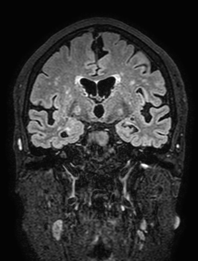 Cavernous hemangioma of the cerebellar falx (Radiopaedia 73025-83724 Coronal FLAIR 164).jpg
