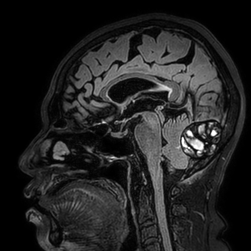 File:Cavernous hemangioma of the cerebellar falx (Radiopaedia 73025-83724 Sagittal FLAIR 105).jpg