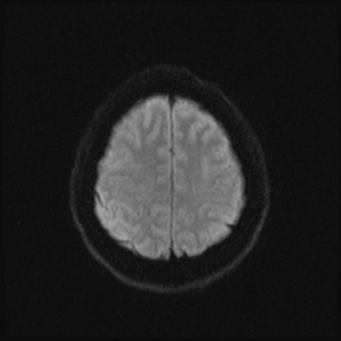 Cavernous sinus meningioma (Radiopaedia 63682-72367 DWI 38).jpg
