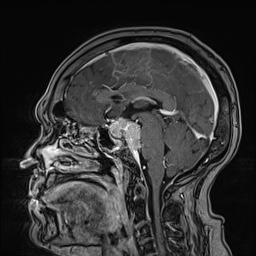 Cavernous sinus meningioma (Radiopaedia 63682-72367 Sagittal T1 C+ 94).jpg