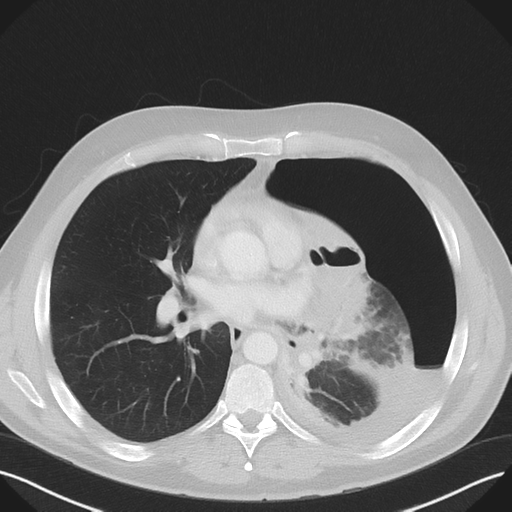 Cavitating pneumonia complicated by pneumothorax (Radiopaedia 48149-52994 Axial lung window 37).png