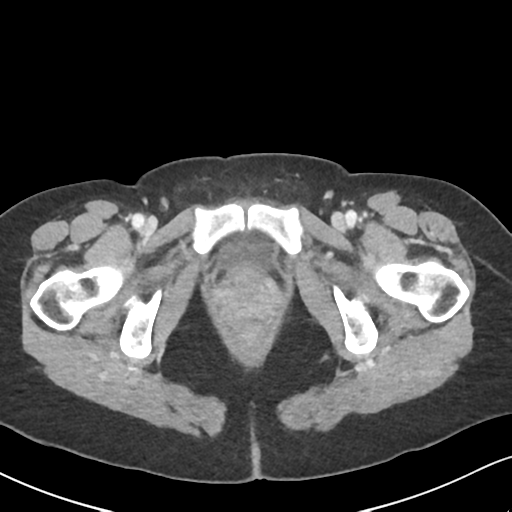 Cecal internal hernia through the foramen of Winslow (Radiopaedia 44820-48651 B 78).png
