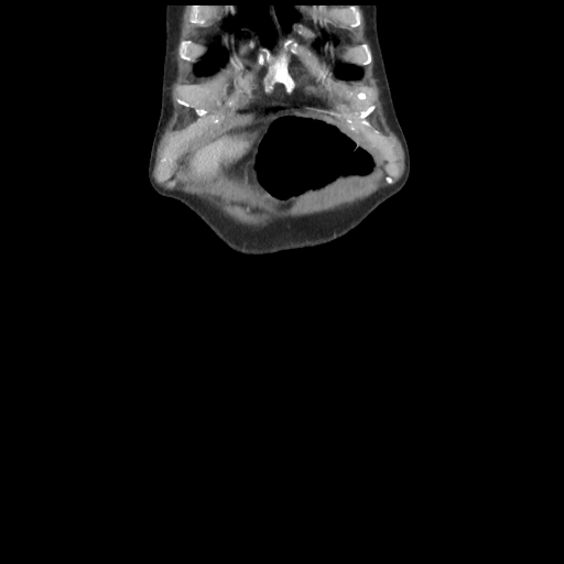 Cecal volvulus (Radiopaedia 89212-106088 E 3).jpg
