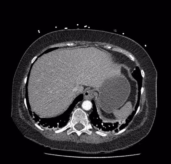 Celiac artery severe stenosis and dissection (Radiopaedia 44128-47842 B 7).jpg