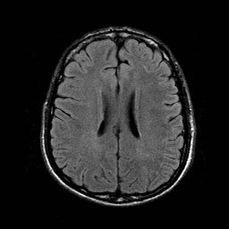 File:Central-variant posterior reversible encephalopathy syndrome (PRES) (Radiopaedia 43880-47359 Axial FLAIR 15).jpg