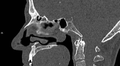 File:Central giant cell granuloma (Radiopaedia 83346-97761 Sagittal bone window 25).jpg
