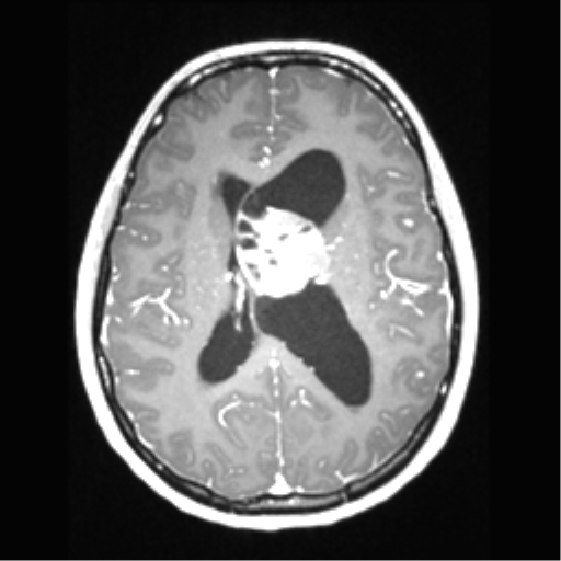 Central neurocytoma (Radiopaedia 37664-39557 Axial T1 C+ 47).png