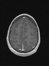 Central neurocytoma (Radiopaedia 56690-63469 Axial T1 C+ 134).jpg