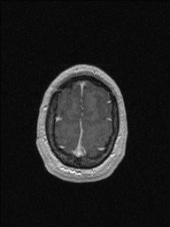 Central neurocytoma (Radiopaedia 56690-63469 Axial T1 C+ 148).jpg