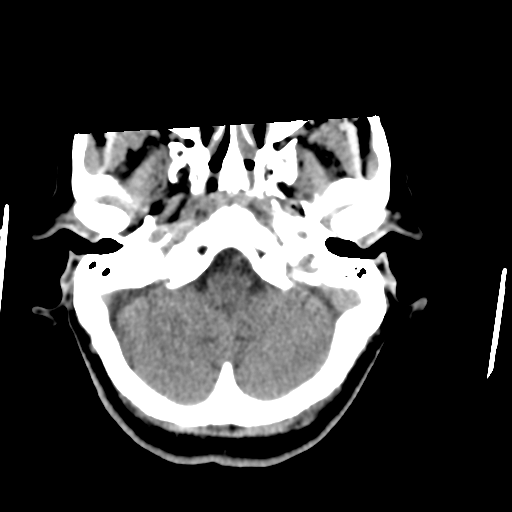Central neurocytoma (Radiopaedia 65317-74346 Axial non-contrast 9).png