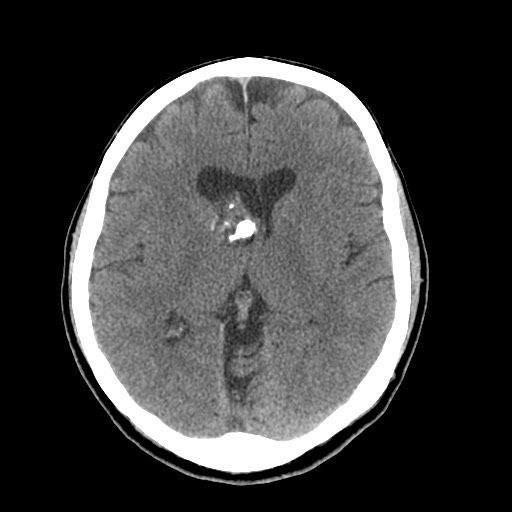 Central neurocytoma (Radiopaedia 68725-78432 Axial non-contrast 26).jpg