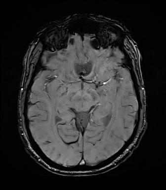 Central neurocytoma (Radiopaedia 71068-81303 Axial SWI 27).jpg