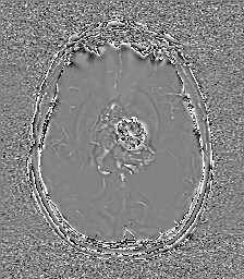Central neurocytoma (Radiopaedia 84497-99872 Axial 38).jpg