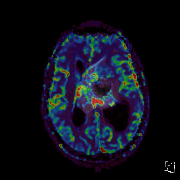 File:Central neurocytoma (Radiopaedia 84497-99872 Axial Perfusion 139).jpg