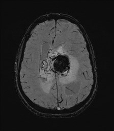 Central neurocytoma (Radiopaedia 84497-99872 Axial SWI 47).jpg