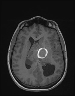 File:Central neurocytoma (Radiopaedia 84497-99872 Axial T1 117).jpg