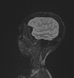 Central neurocytoma (Radiopaedia 84497-99872 Sagittal Flair + Gd 30).jpg