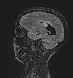 Central neurocytoma (Radiopaedia 84497-99872 Sagittal Flair + Gd 52).jpg