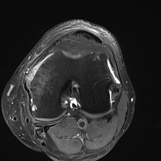 File:Central osteophyte (Radiopaedia 72592-83151 Axial PD fat sat 16).jpg