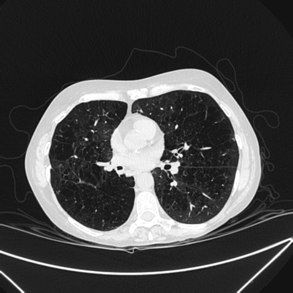 Centrilobular pulmonary emphysema (Radiopaedia 24495-24789 Axial lung window 52).jpg