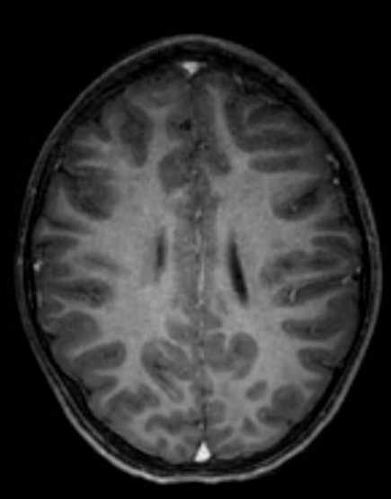 Cerebellar abscess (Radiopaedia 73727-84563 Axial T1 C+ fat sat 76).jpg