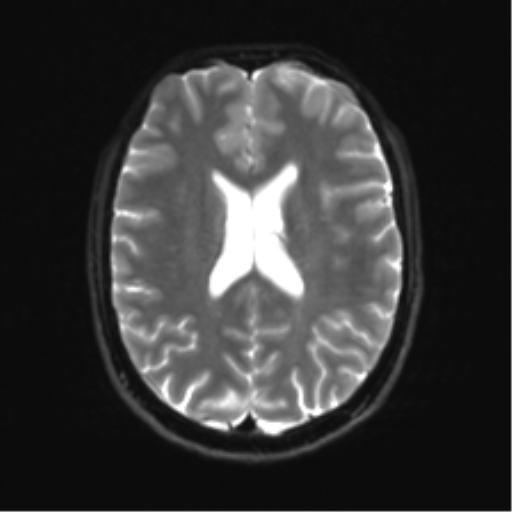 Cerebellar agenesis with hypoplastic pons (pontocerebellar hypoplasia) (Radiopaedia 57224-64138 Axial DWI 24).png