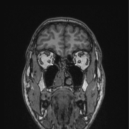 Cerebellar hemangioblastomas and pituitary adenoma (Radiopaedia 85490-101176 Coronal T1 74).png