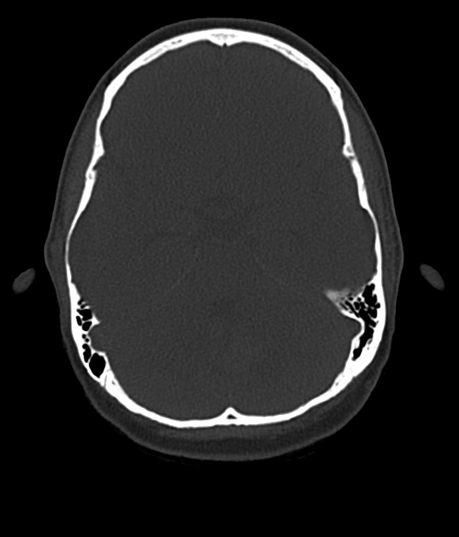 File:Cerebellar metastases - colorectal adenocarcinoma (Radiopaedia 40947-43652 AX Bone C- 2.0 MPR 20).png