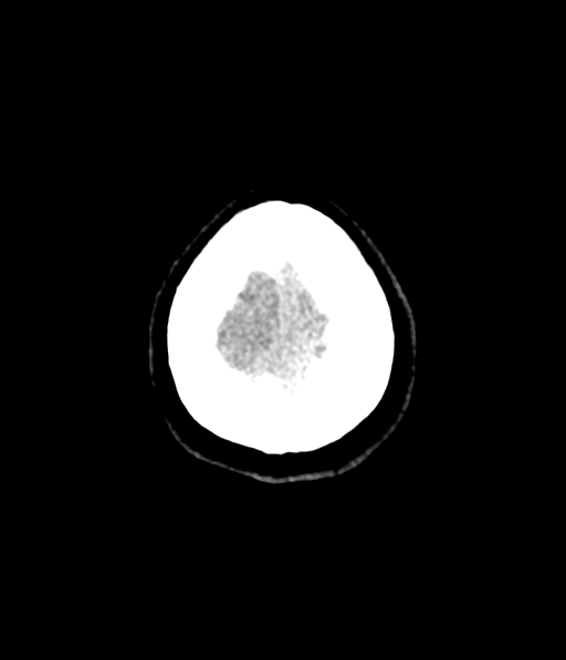 Cerebellar metastases - colorectal adenocarcinoma (Radiopaedia 40947-43652 Axial non-contrast 64).png