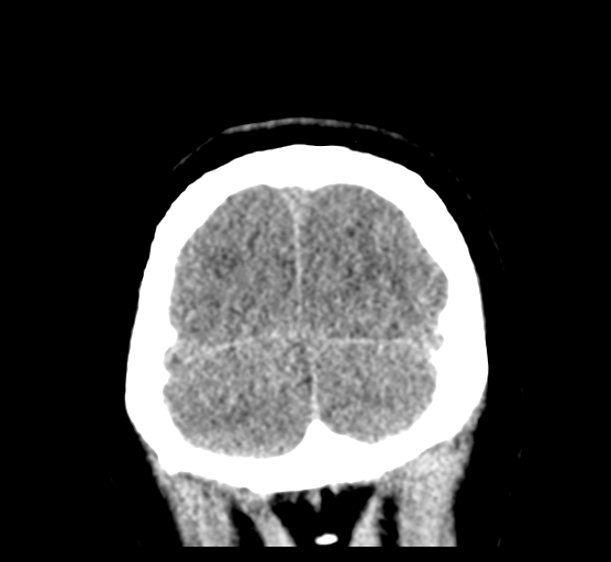 Cerebellar metastases - colorectal adenocarcinoma (Radiopaedia 40947-43652 Coronal non-contrast 84).png