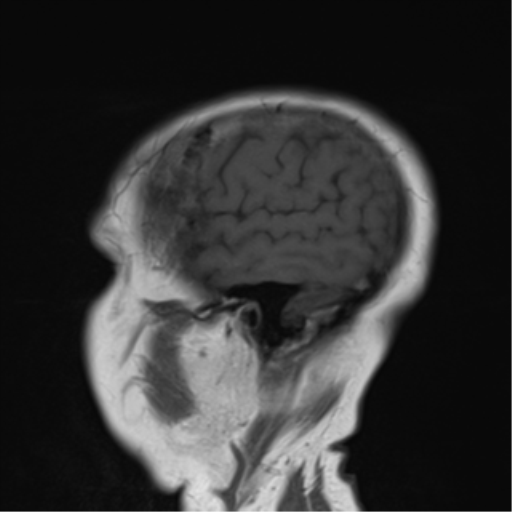 File:Cerebellar metastasis (Radiopaedia 54578-60810 Sagittal T1 19).png
