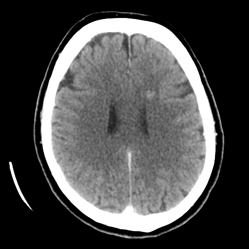 Cerebellar metastasis (cystic appearance) (Radiopaedia 41395-44258 B 33).png