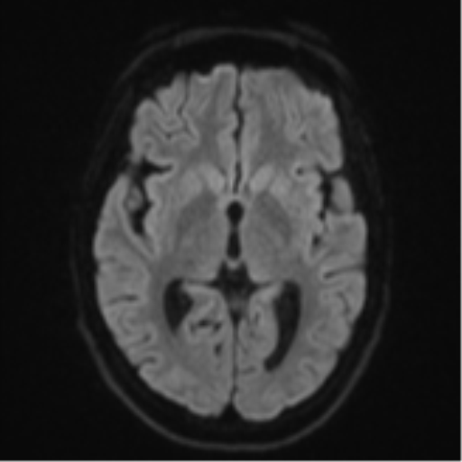 Cerebellar metastasis - adenocarcinoma lung (Radiopaedia 63184-71715 Axial DWI 43).png
