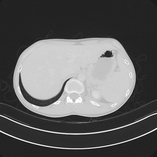 Cerebellar metastasis - adenocarcinoma lung (Radiopaedia 63184-71717 Axial lung window 65).png