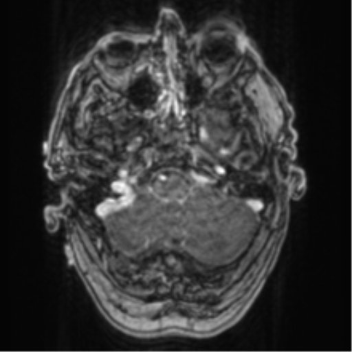 Cerebellar metastasis from lung adenocarcinoma (Radiopaedia 86690-102829 Axial T1 C+ 17).png