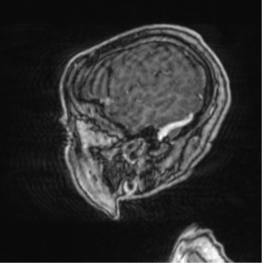 Cerebellar metastasis from lung adenocarcinoma (Radiopaedia 86690-102829 Sagittal T1 C+ 14).png