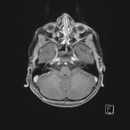 File:Cerebellar stroke (Radiopaedia 32202-33150 Axial T1 C+ 24).png