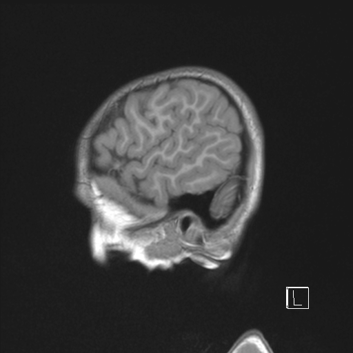 Cerebellar stroke (Radiopaedia 32202-33150 Sagittal T1 C+ 47).png