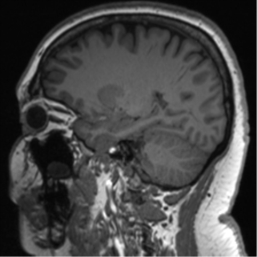 Cerebellopontine angle meningioma (Radiopaedia 48434-53348 Sagittal T1 59).png
