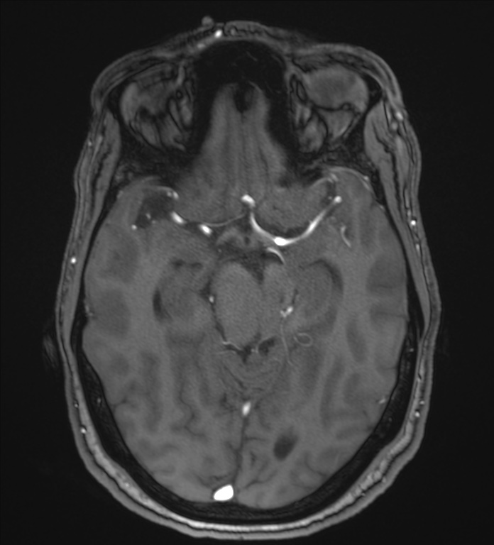 Cerebellopontine angle meningioma (Radiopaedia 72983-83680 Axial MRA 50).jpg